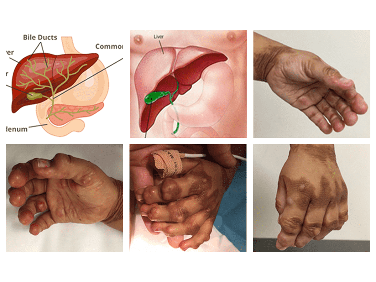 alagille-syndrome-in-hindi