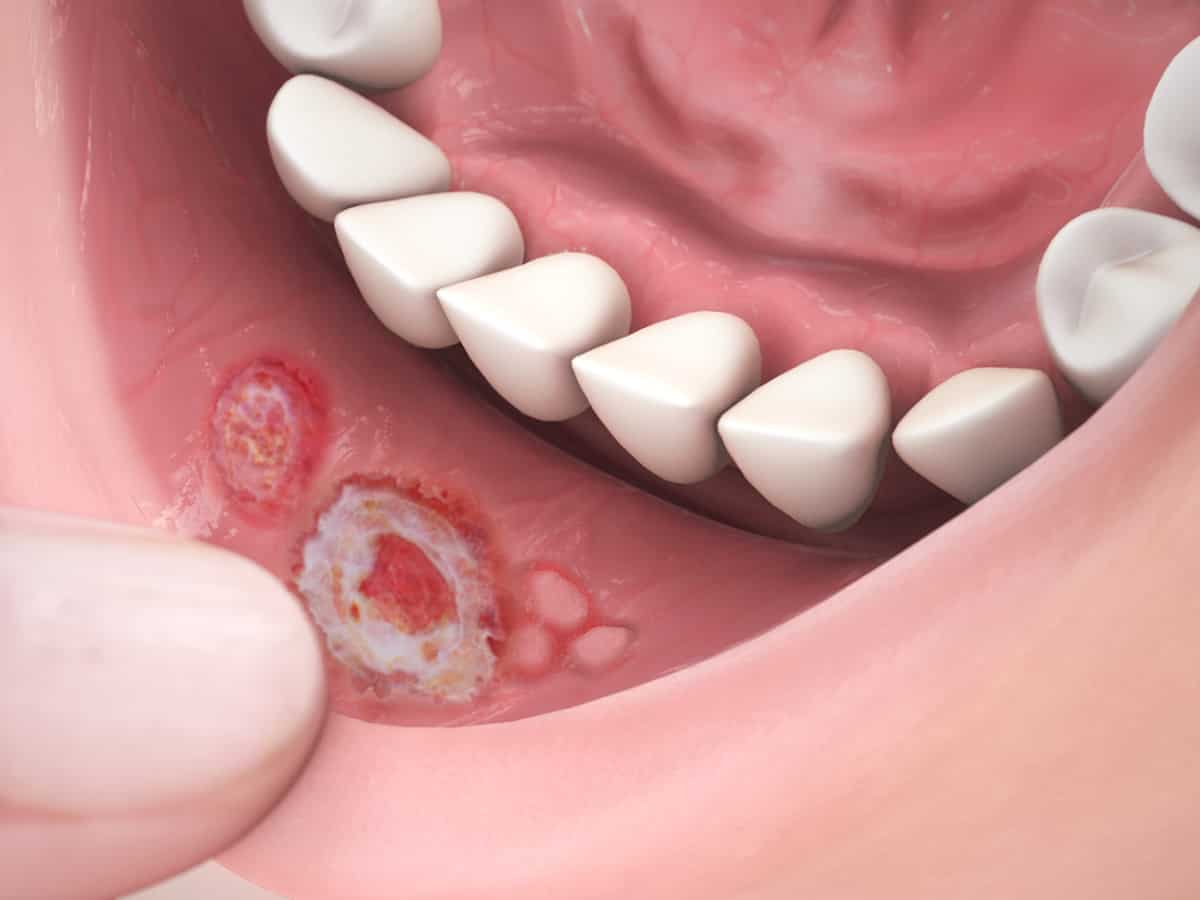 what is mouth ulcer in hindi