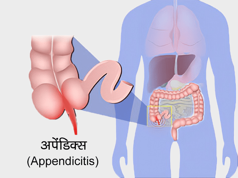 Appendicitis in Hindi