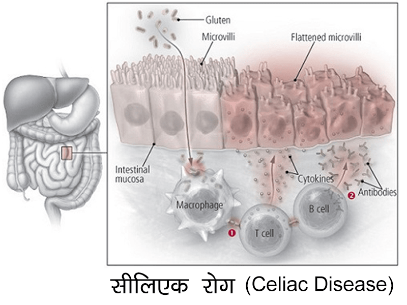 Celiac Disease in Hindi