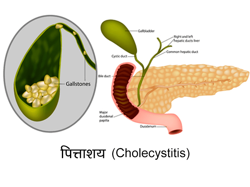 Cholecystitis in Hindi