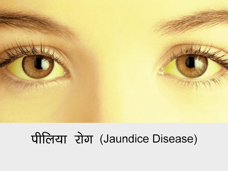 Jaundice Disease in Hindi