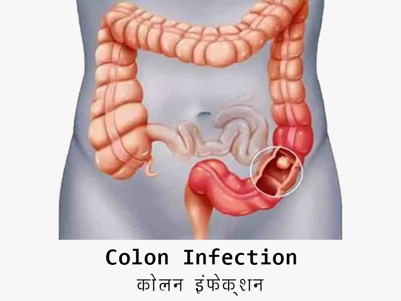 Colon Infection in Hindi