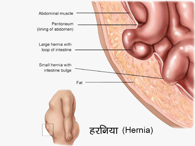 Hernia in Hindi