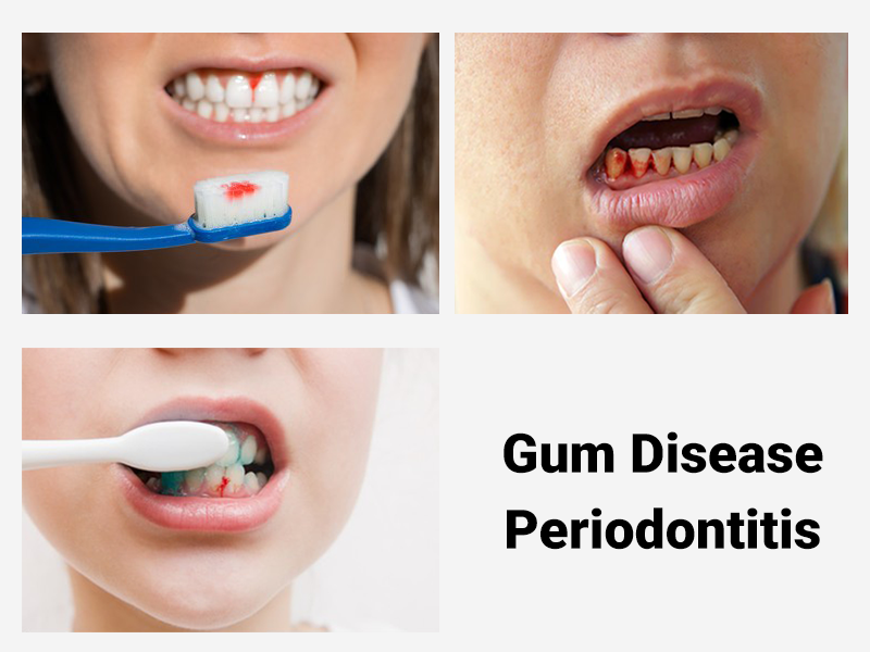 Gum Disease Periodontitis in Hindi