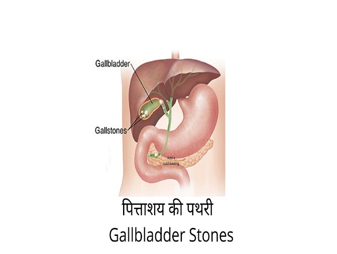 Gallbladder Stones in Hindi