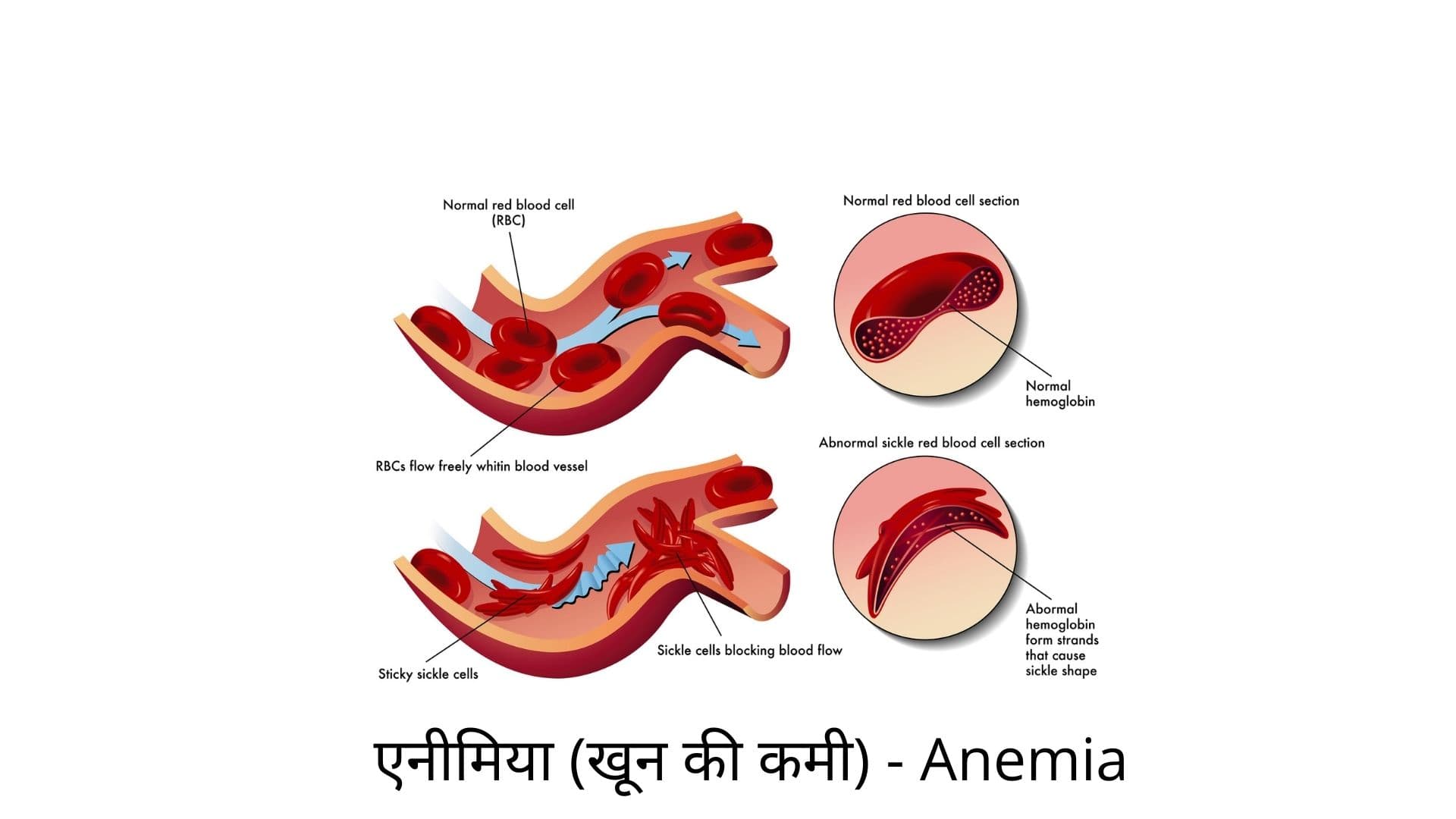 Anemia in Hindi