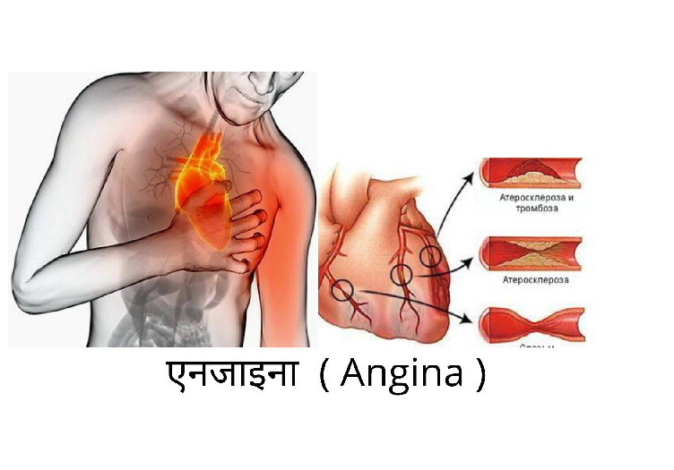 एनजाइना - Angina in Hindi