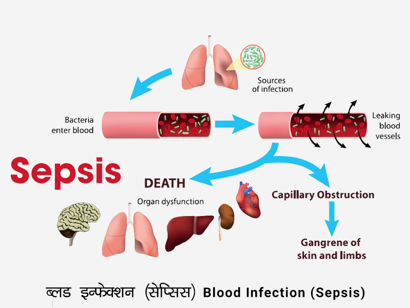 Blood Infection (Sepsis)