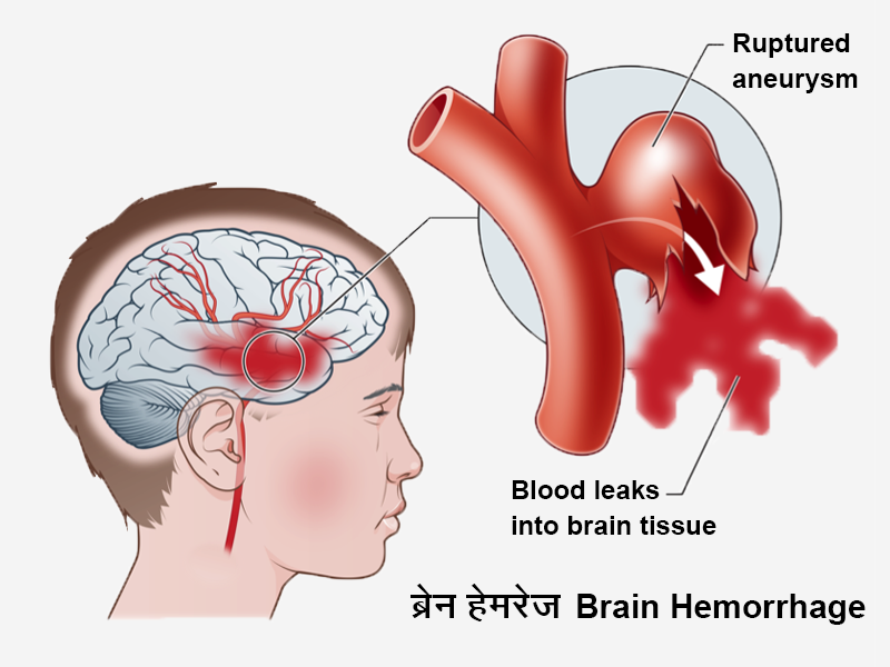 Brain_Hemorrhage