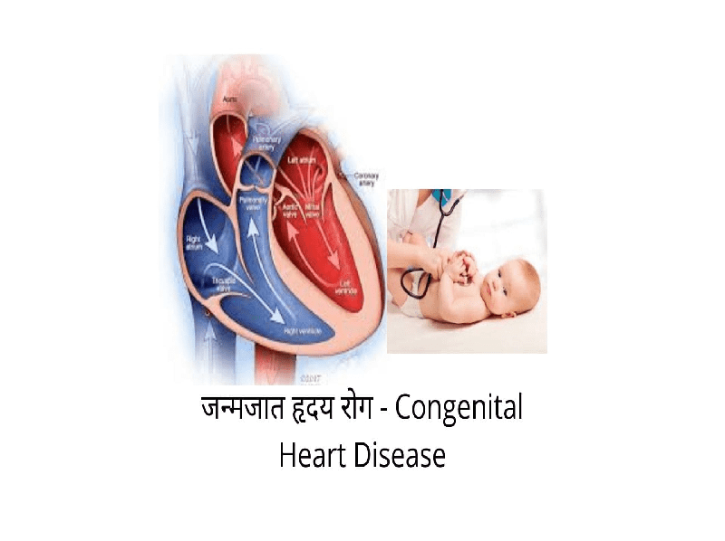 congenital heart disease