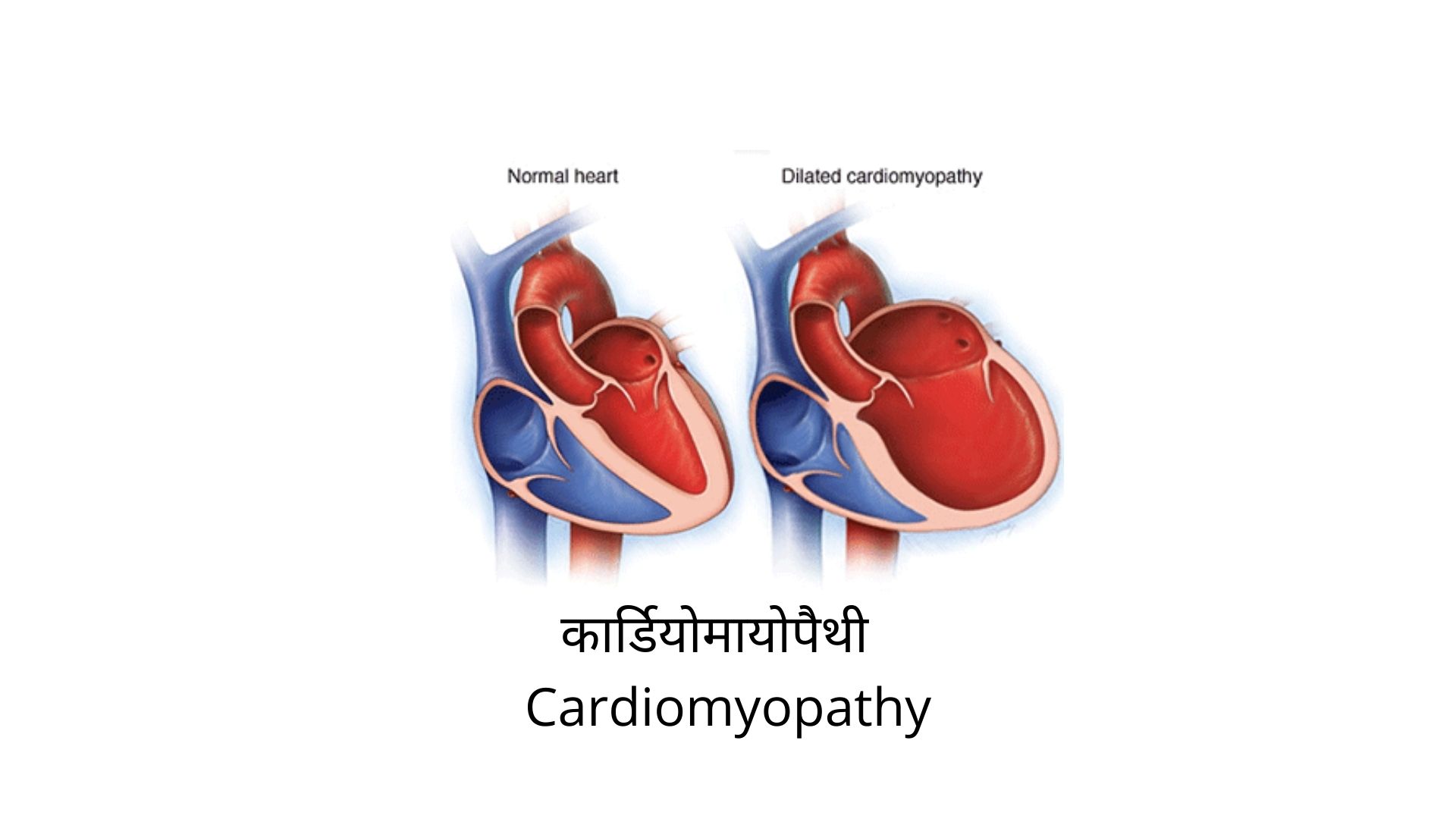 कार्डियोमायोपैथी Cardiomyopathy