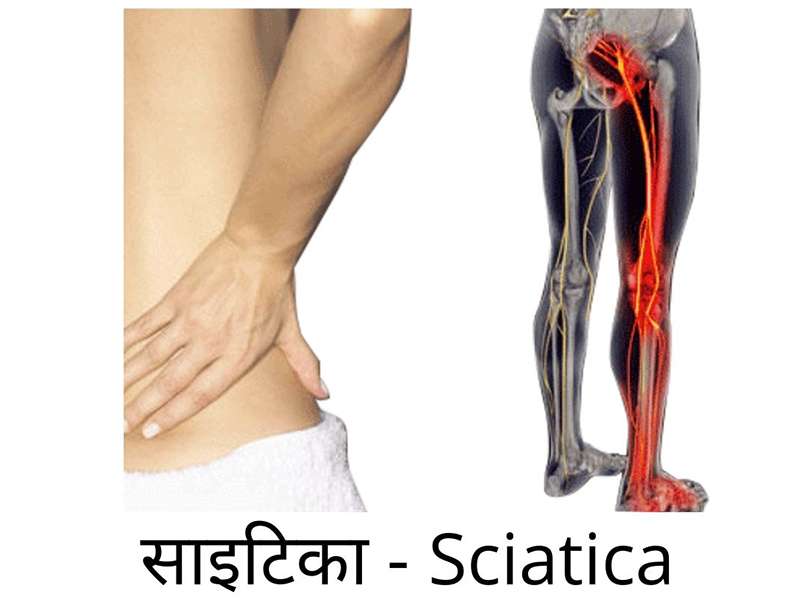 साइटिका - Sciatica